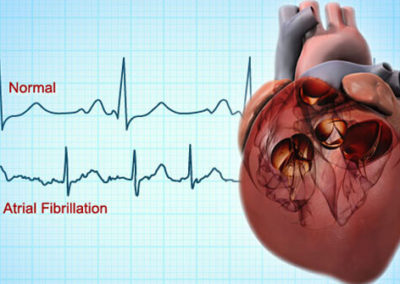 What to do about my Atrial Fibrillation?