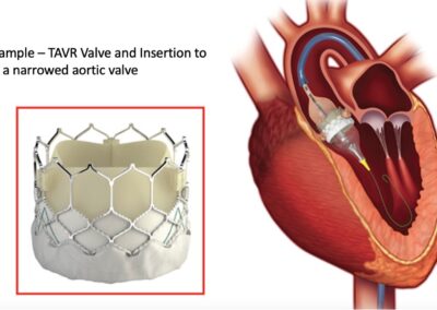 TAVR: Replacing the Aortic Valve without Open Heart Surgery